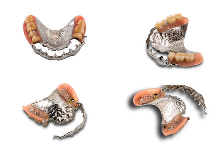 Upper partial metal swinglock type denture open and close on white background.