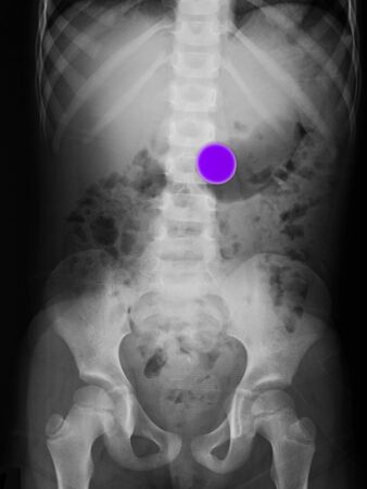 abdomen x-ray of a 5 year old girl who swallowed a quarter.  The quarter, highlighted in violet, is...