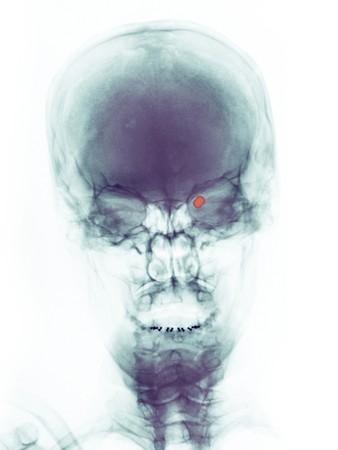 skull x-ray of a 73 year old woman who was shot in the right eye with a pellet gun. The pellet can be seen within the orbit of the eye.の写真素材