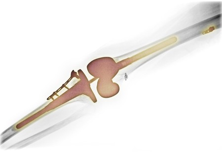 x-ray of the leg of a 46 year old female who had surgery for a total knee replacementの写真素材