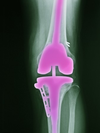 x-ray of the leg of a 46 year old female who had surgery for a total knee replacementの写真素材