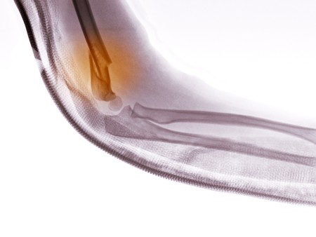 X-ray of the arm of a 4 year old boy showing a fracture of the distal humerus.  A fiberglass splint has been applied to the arm for stabilization.の写真素材