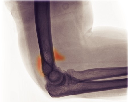 elbow x-ray of a 71 year old man who fell and sustained an occult fracture of the elbow.   The x-ray shows anterior and posterior fat pad signs.の写真素材