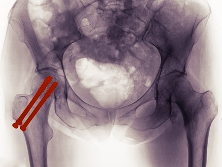 Pelvis x-ray of a 65 year old female showing the repair of a hip fracture with 2 screws through the neck of the femur. On the other side there is a fracture of the lesser trochanterの写真素材