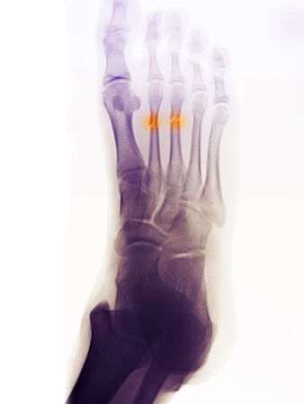 Foot x-ray of a 14 year old boy who fractured his 2nd and 3rd metatarsalsの写真素材