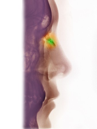 X-ray of the nasal bones of a 13 year old boy showing a fracture from being punched in the noseの写真素材