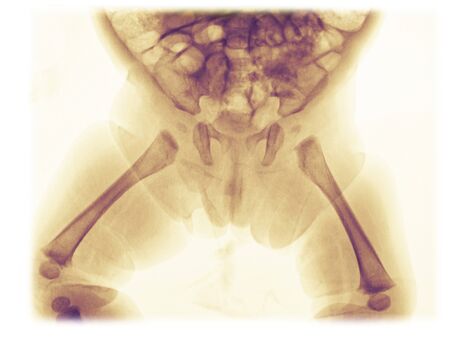 Pelvis x-ray of a 3 month old girl showing normal anatomy of the developing bonesの写真素材