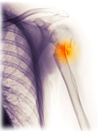 X-ray of the shoulder of a 54 year old man who fell and fractured his proximal humerus.の写真素材