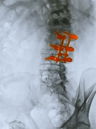 Lumbar spine x-ray of an 80 year old man who underwent a spinal fusion operation.  This patient also had a kyphoplasty for compression fractures of the two vertebrae above the area of spinal fusion.  Kyphoplasty is a medical procedure that attempts to stoの写真素材