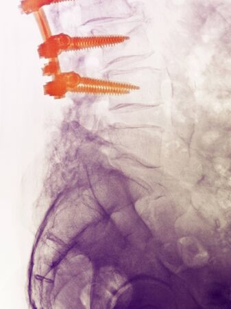 Lumbar spine x-ray of an 80 year old man who underwent a spinal fusion operationの写真素材