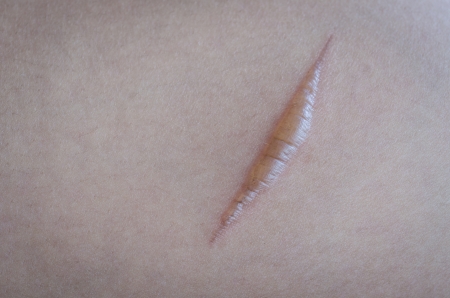 Burning blisters on the skinの写真素材