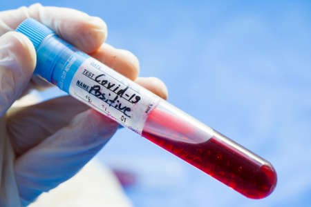 Corona virus positive blood test tubes on the white background, studio shoot. Blood test samples. Diagnosis and laboratory.の写真素材