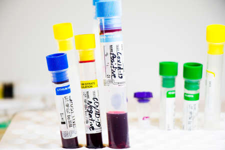 Corona virus and Covid-19 positive blood test tubes on the white background, studio shoot. Blood test samples. Diagnosis and laboratory.のeditorial素材