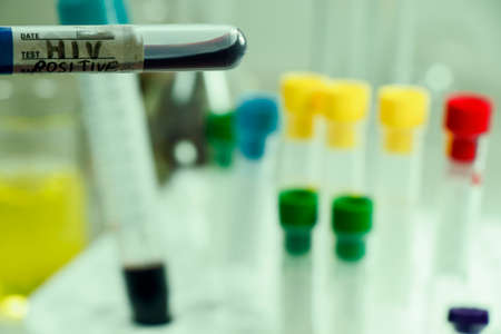 Hiv and aids infection blood test sample, diagnoses and laboratory chemical liquid elements, studio...