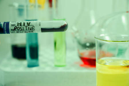 HIV blood test tube sample, aids immune viruses.の写真素材