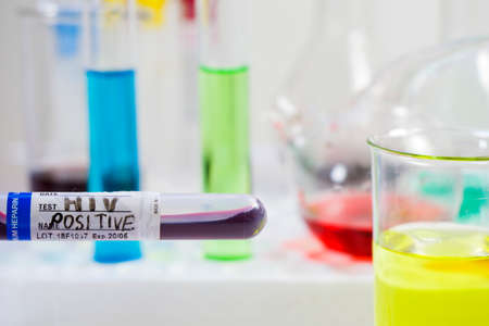 HIV blood test tube sample, aids immune viruses.の写真素材