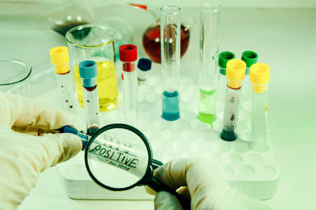 HIV blood test tube sample, aids immune viruses.