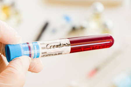 Creatinine blood test tube sample in doctors hand holding in laboratory, white background