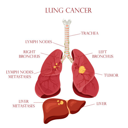 Vector of Diagram lung cancer disease. - ID:1-189163643 - Royalty Free ...