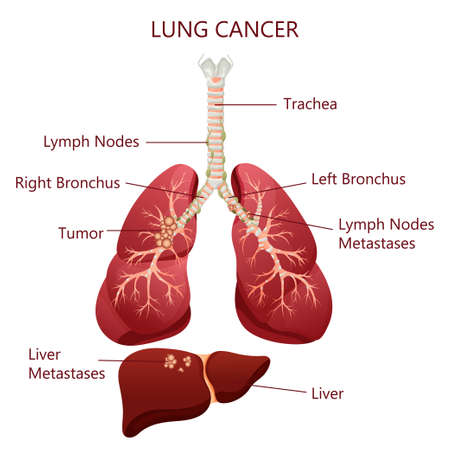 Vector of Diagram lung cancer disease. - ID:1-189163650 - Royalty Free ...