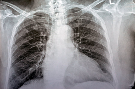 Plain x ray chest of an old woman with almost normal study of bones, lungs and heart, normal chest cavity, ribs and wall, no signs of white patches or pneumonia, with normal sizes and shapesの写真素材