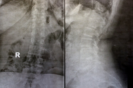 Plain x ray of dorsal and lumber spine reveals spondylotic changes, straightening of dorsal and...