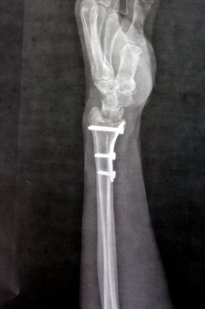 Plain x ray showing a recent fissure fracture at the lower part of a left radius bone, also showing a previous internal fixation of the wrist join with plate and screws of a previous fractureの写真素材