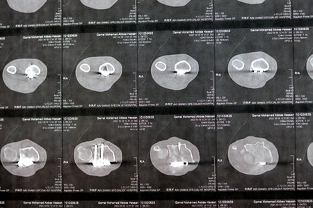 Cairo, Egypt, October 18 2023: CT scan left wrist joint showing a recent fissure fracture at the...