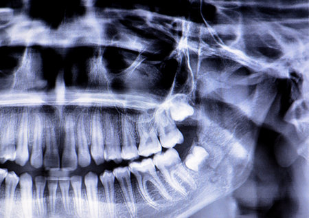 A panoramic radiograph of a girl fracture of the jawbone after a direct trauma to the left side, a panoramic scanning dental X-ray of the upper and lower jaw, shows a two-dimensional viewの写真素材