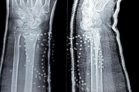 Colles fracture healing of an old female, a type of fracture of the distal forearm, the broken end...