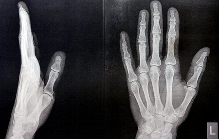 Plain x ray of the left hand of an adult male after a direct trauma to the left thumb finger showing...
