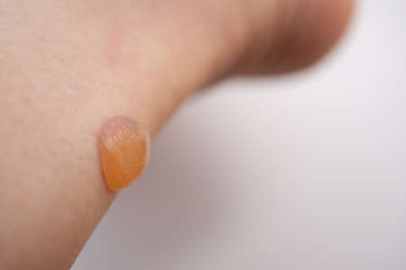 blisters on a woman's feetの写真素材