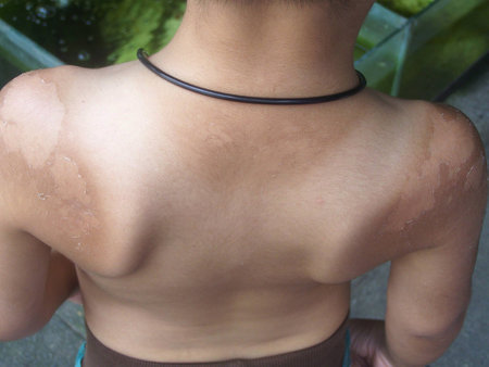 the skin is infected and is scratched is the wound , be born from the sun light that burn while , have a swim on seashore beach by no rub the sunscreen protects ,の写真素材