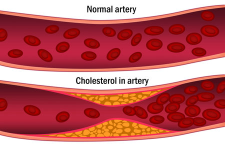 Cholesterol in artery. Medical concept, 3d renderingの写真素材
