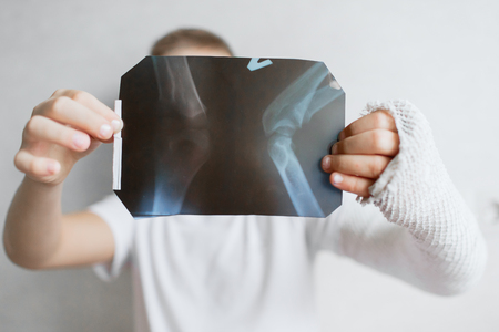 The boy with a broken hand looks at the X-ray. X-ray in the hands of a sad boy with a broken arm.の写真素材