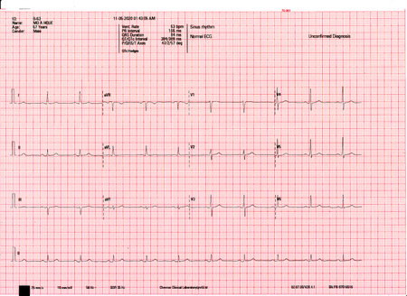 A normal resting ECG report of a patient. Echocardiogram report of a 67 years male patient.の写真素材