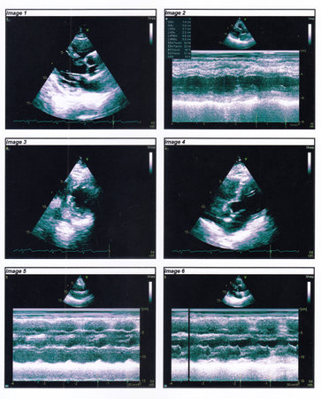 An echocardiography in 2d and M-Mode (TTE). Good LV systolic functionの写真素材