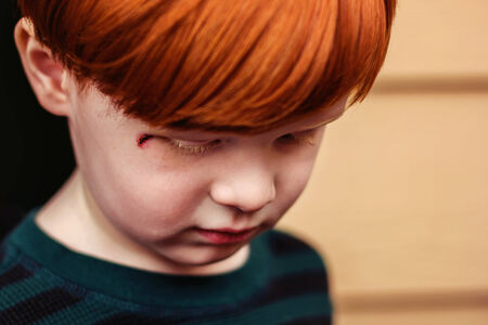 4 year old redheaded boy looking down, with two stitches near his eye from fallingの写真素材
