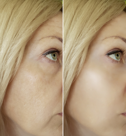 face woman wrinkles before and afterの写真素材