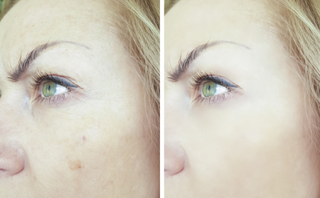 face woman wrinkles before and afterの写真素材