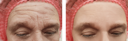 wrinkles face elderly woman