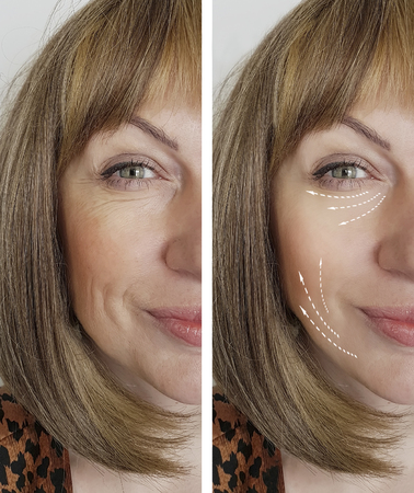 woman wrinkles before and after procedures