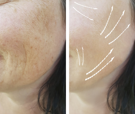 elderly woman, facial wrinkles before and after procedures, bloating, pigmentation