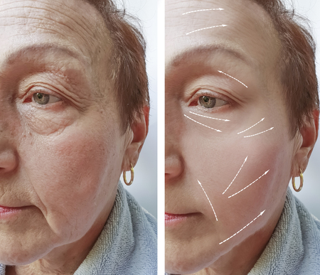woman wrinkles on face before and after