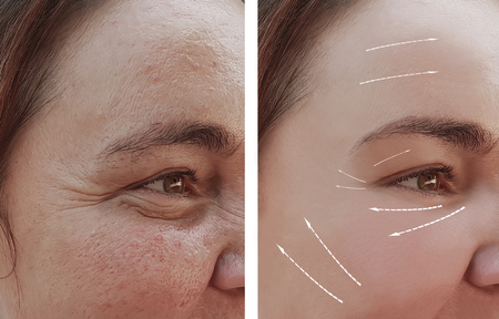 female facial wrinkles before and after cosmetic procedures, arrow
