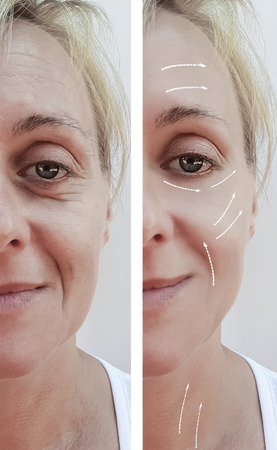 female facial wrinkles before and after cosmetic procedures, arrowの写真素材
