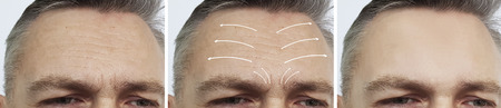 male wrinkles before and after treatment