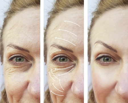 woman facial wrinkles correction before and after procedures