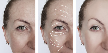 woman wrinkles correction before and after treatments arrow