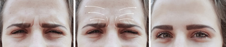 woman facial wrinkles correction before and after procedures arrowの写真素材